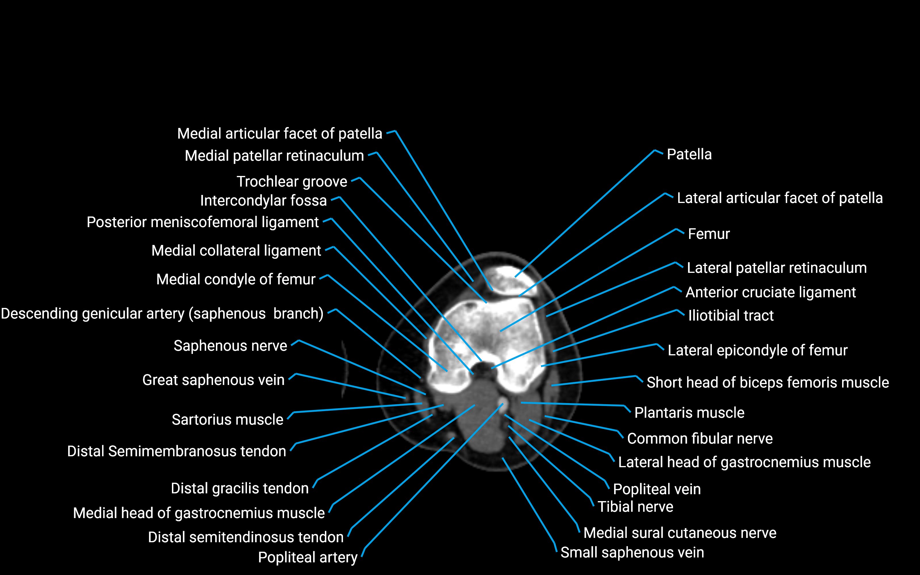 CT Lower leg axial cross sectional anatomy labelled image 85 (2).png